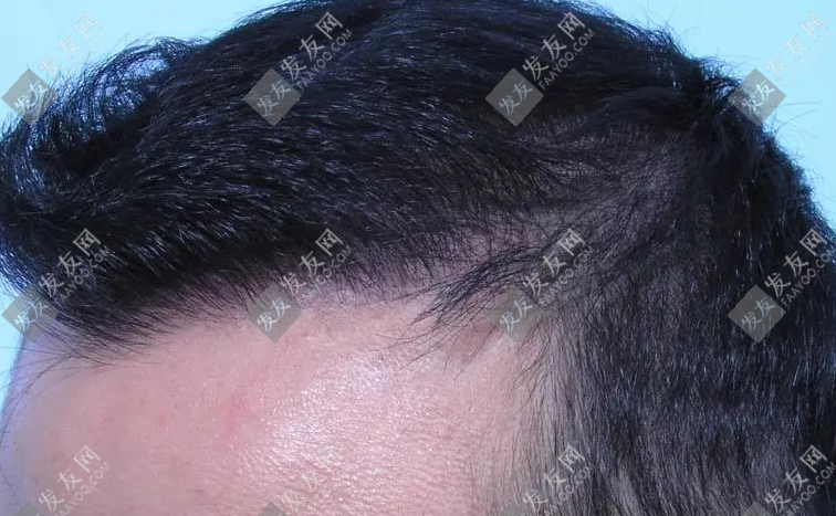 濰坊植發(fā)價(jià)格多少錢一般