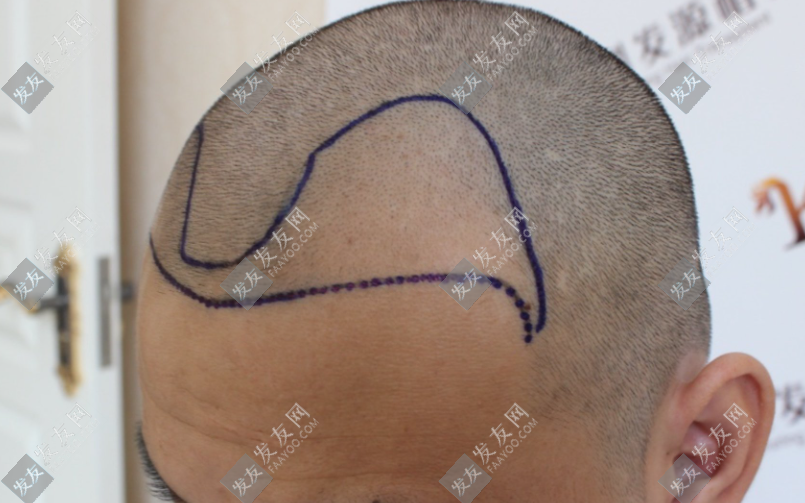 南陽植發(fā)價格多少錢左右