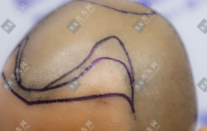 南陽正規(guī)植發(fā)醫(yī)院排名