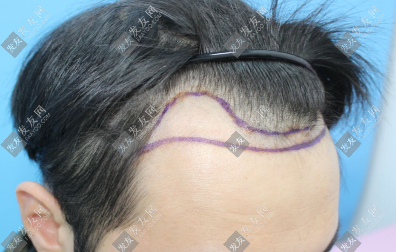 東莞正規(guī)植發(fā)醫(yī)院排名