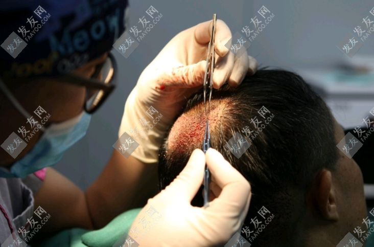 衡陽植發(fā)醫(yī)院哪家比較好