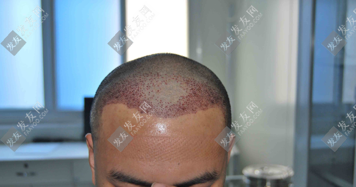 青云植發(fā)價格表